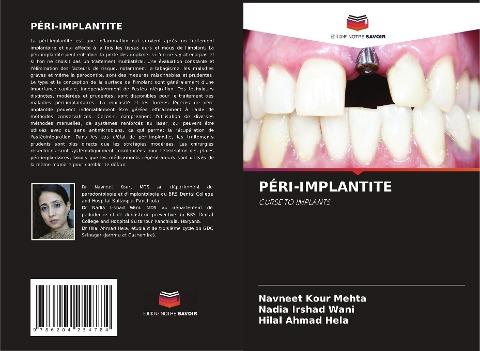 PÉRI-IMPLANTITE