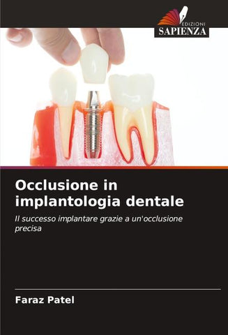 Occlusione in implantologia dentale