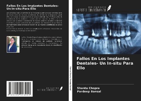 Fallos En Los Implantes Dentales- Un In-situ Para Ello