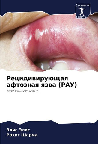 Recidiwiruüschaq aftoznaq qzwa (RAU)