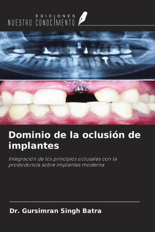 Dominio de la oclusión de implantes