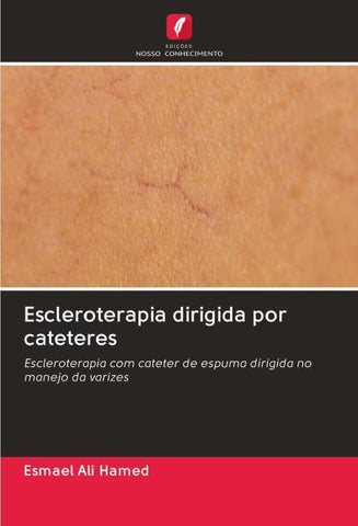 Escleroterapia dirigida por cateteres