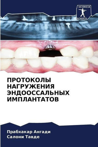 PROTOKOLY NAGRUZhENIYa JeNDOOSSAL'NYH IMPLANTATOV