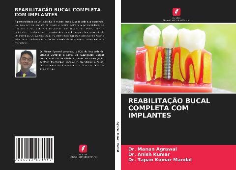 REABILITAÇÃO BUCAL COMPLETA COM IMPLANTES