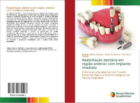 Reabilitação dentária em região anterior com Implante Imediato