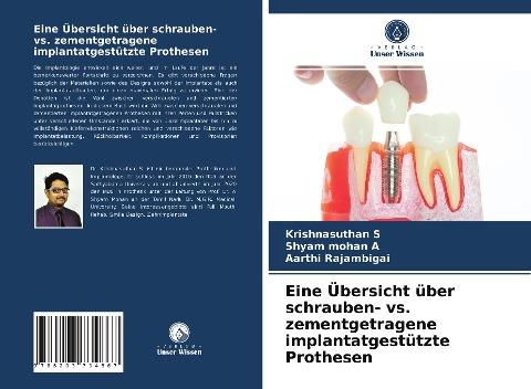 Eine Übersicht über schrauben- vs. zementgetragene implantatgestützte Prothesen