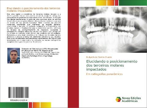 Elucidando o posicionamento dos terceiros molares impactados