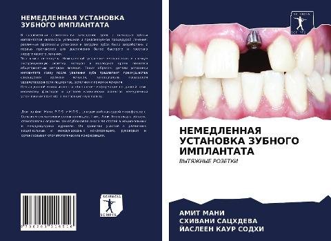 NEMEDLENNAYa USTANOVKA ZUBNOGO IMPLANTATA