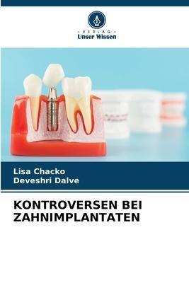 KONTROVERSEN BEI ZAHNIMPLANTATEN