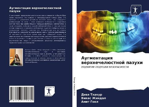 Augmentaciq werhnechelüstnoj pazuhi