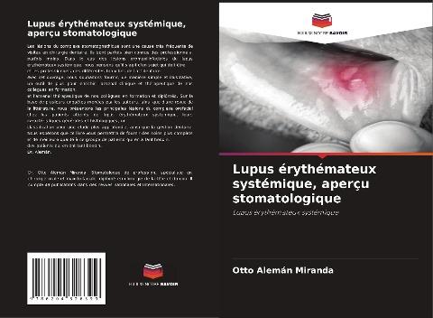 Lupus érythémateux systémique, aperçu stomatologique