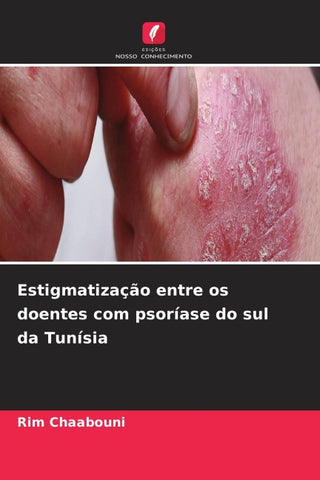 Estigmatização entre os doentes com psoríase do sul da Tunísia
