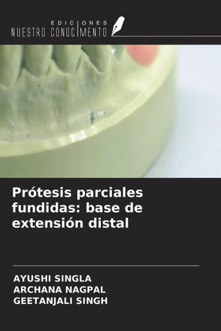 Prótesis parciales fundidas: base de extensión distal