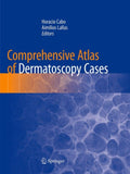 Comprehensive Atlas of Dermatoscopy Cases