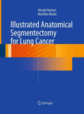 Illustrated Anatomical Segmentectomy for Lung Cancer