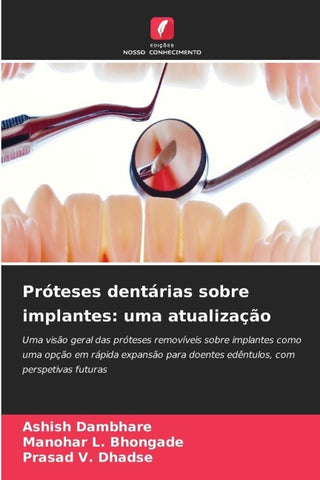 Próteses dentárias sobre implantes: uma atualização
