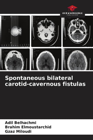 Spontaneous bilateral carotid-cavernous fistulas