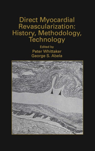 Direct Myocardial Revascularization: History, Methodology, Technology