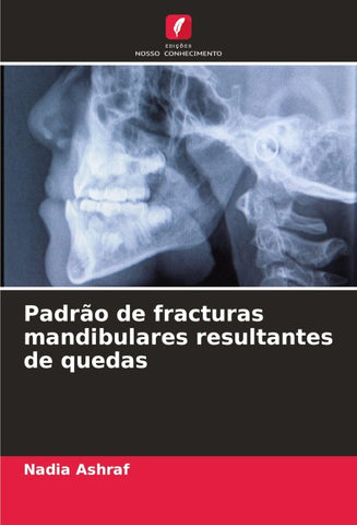 Padrão de fracturas mandibulares resultantes de quedas