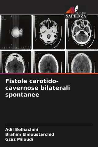 Fistole carotido-cavernose bilaterali spontanee