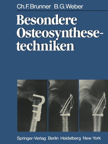 Besondere Osteosynthesetechniken