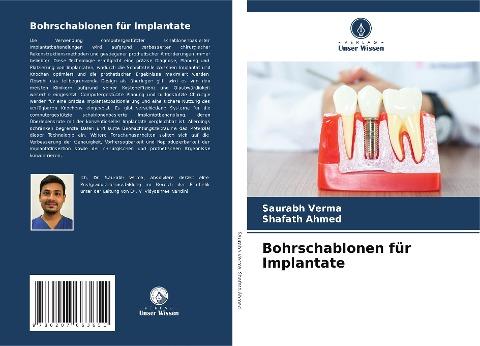 Bohrschablonen für Implantate