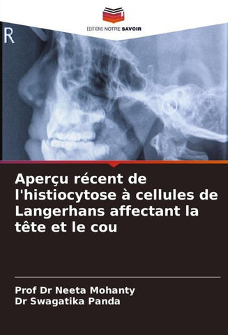 Aperçu récent de l'histiocytose à cellules de Langerhans affectant la tête et le cou
