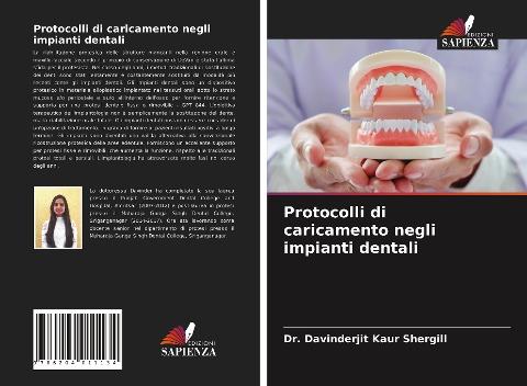 Protocolli di caricamento negli impianti dentali