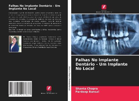 Falhas No Implante Dentário - Um Implante No Local