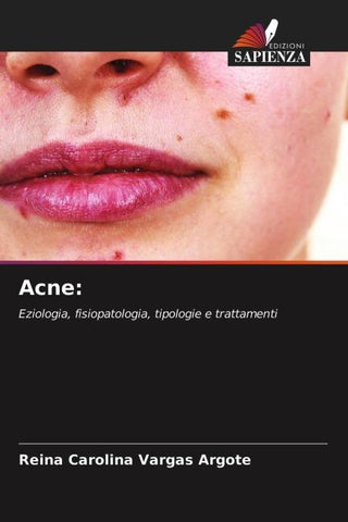 Acne: