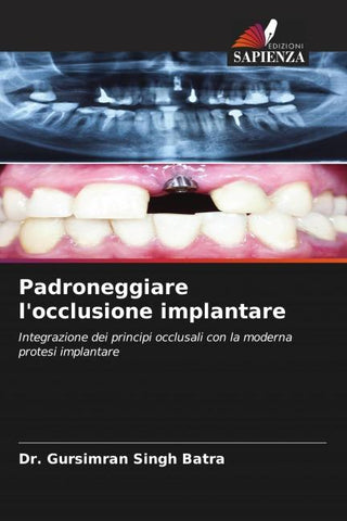 Padroneggiare l'occlusione implantare