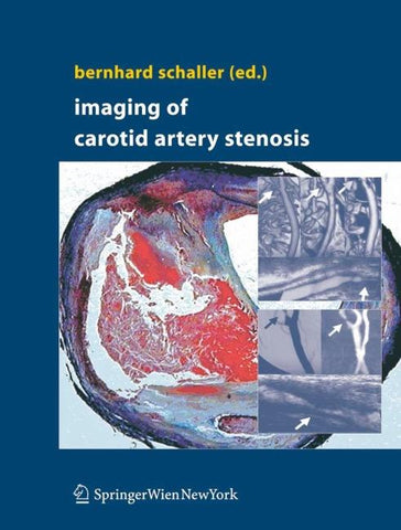 Imaging of Carotid Artery Stenosis