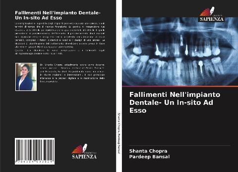 Fallimenti Nell'impianto Dentale- Un In-sito Ad Esso