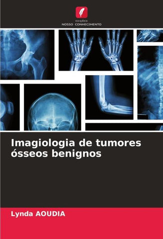 Imagiologia de tumores ósseos benignos