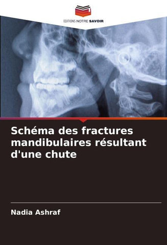 Schéma des fractures mandibulaires résultant d'une chute
