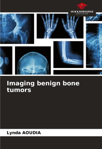 Imaging benign bone tumors