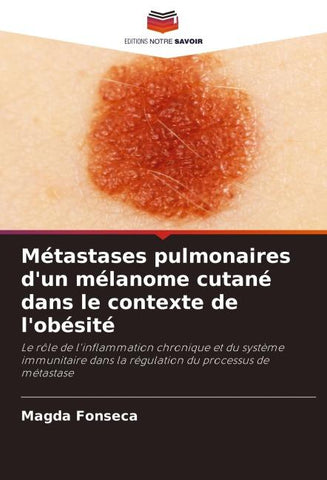Métastases pulmonaires d'un mélanome cutané dans le contexte de l'obésité