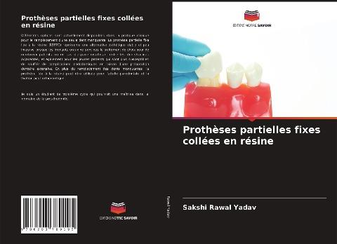 Prothèses partielles fixes collées en résine