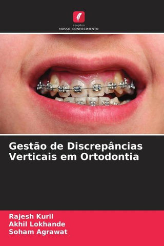 Gestão de Discrepâncias Verticais em Ortodontia