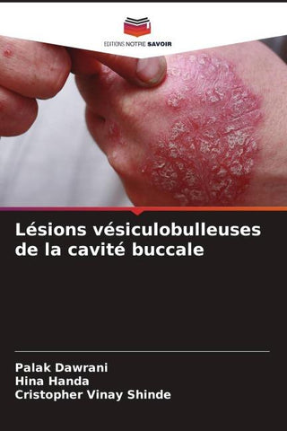Lésions vésiculobulleuses de la cavité buccale