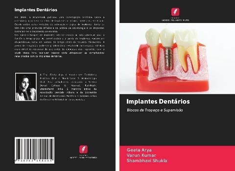 Implantes Dentários