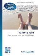 Varicose veins