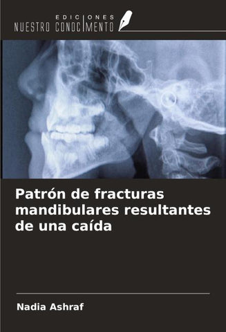 Patrón de fracturas mandibulares resultantes de una caída