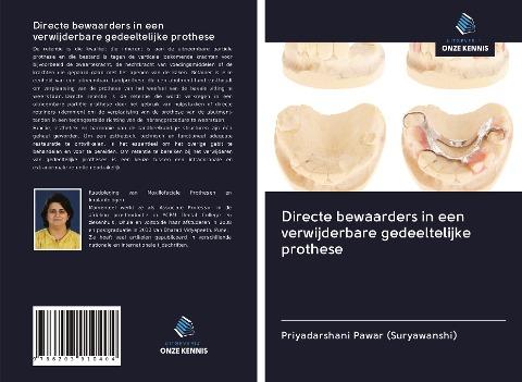 Directe bewaarders in een verwijderbare gedeeltelijke prothese