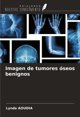 Imagen de tumores óseos benignos