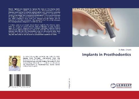 Implants in Prosthodontics