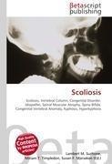 Scoliosis