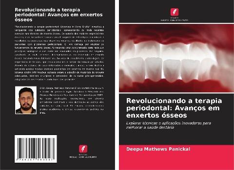 Revolucionando a terapia periodontal: Avanços em enxertos ósseos