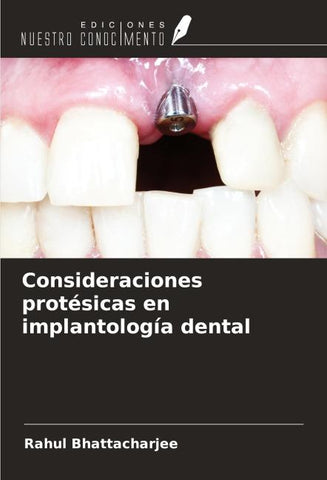 Consideraciones protésicas en implantología dental